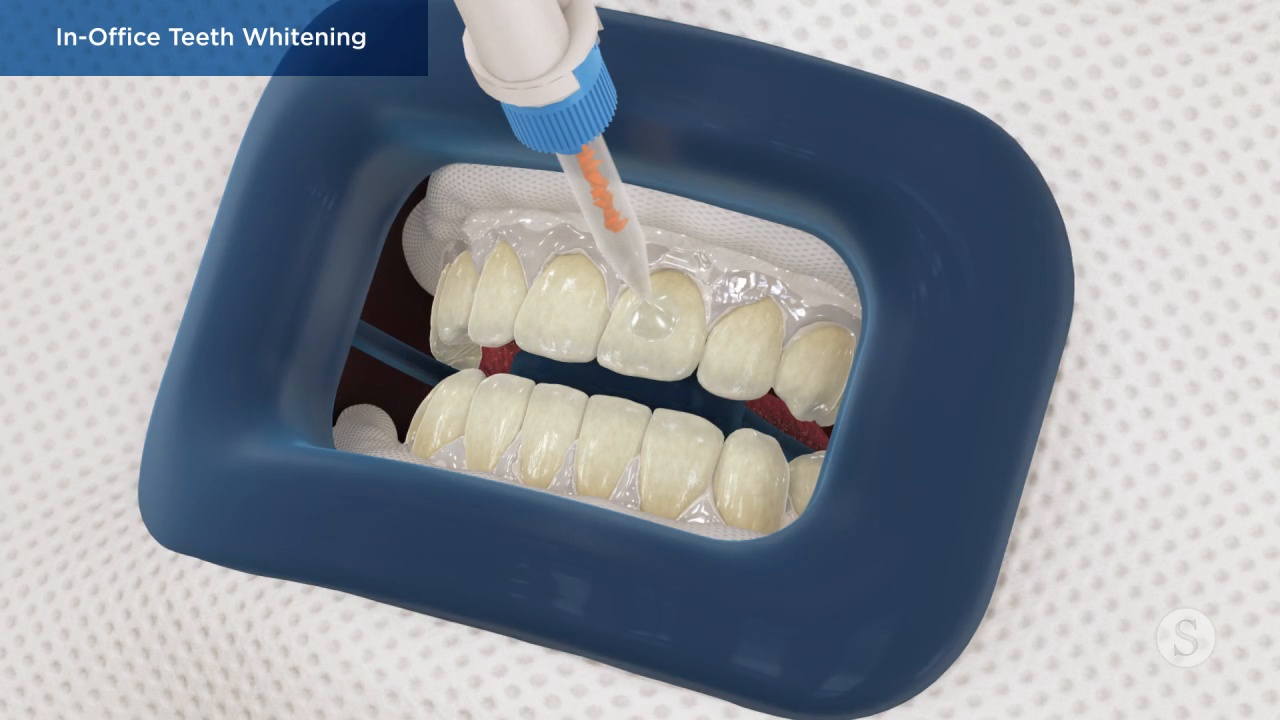 In-Office Teeth Whitening